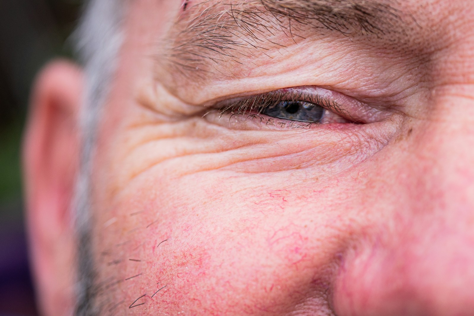 Lerchek Loses Vision in Right Eye Due to Skull Bone Damage - News