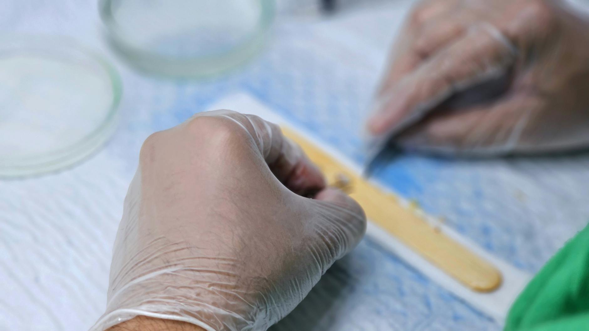 Moscow Pioneers Hand Transplant Surgeries: A Medical Breakthrough - News